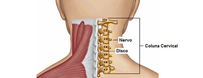 Dores na Cervical Hernia de Disco