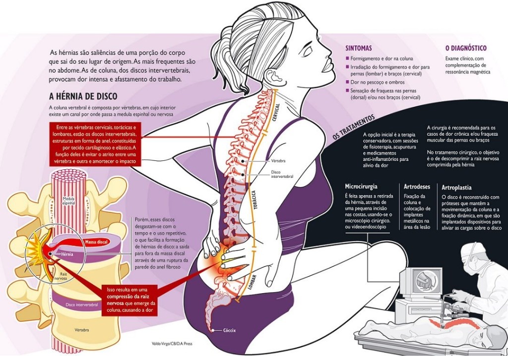 hérnia_de_disco_trtramento_