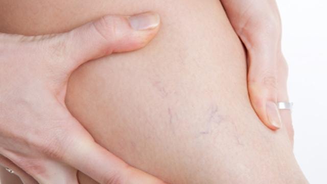 Musculação provoca Varizes