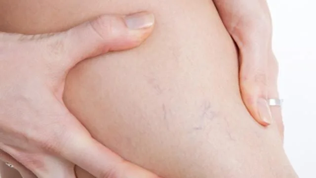 Musculação provoca Varizes