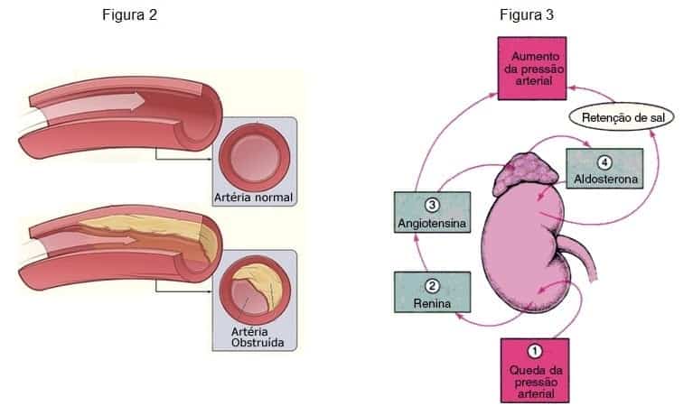Hipertensao Arterial e Musculacao