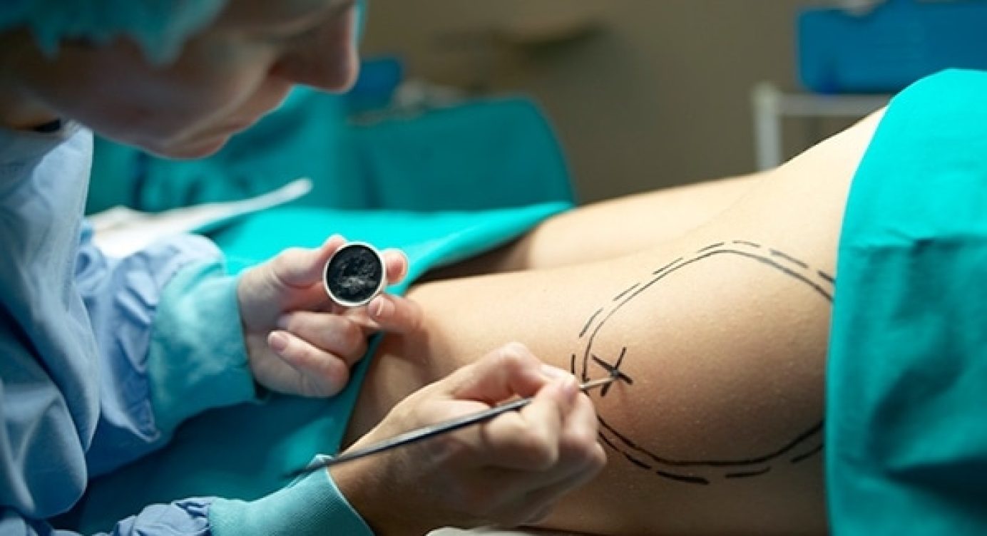 Conheça os Malefícios da Lipoaspiração e porque ela pode Não ajudar a Perder Barriga