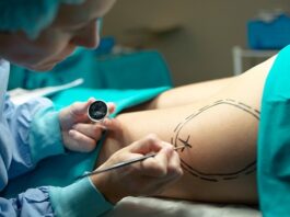 Lipoaspiração