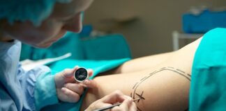 Lipoaspiração