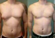 Antes e Depois Ginecomastia