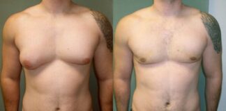 O que é Ginecomastia, como surge, como evitar e tratamentos Antes e depois de tratamento contra ginecomastia masculina.
