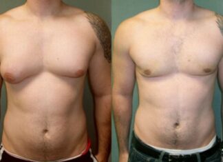 Antes e Depois Ginecomastia