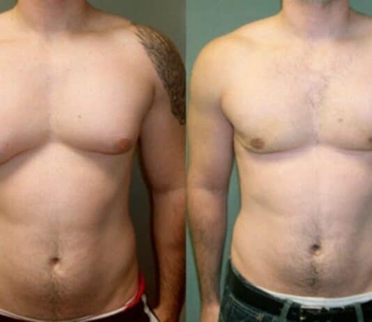 O que é Ginecomastia, como surge, como evitar e tratamentos Antes e depois de tratamento contra ginecomastia masculina.
