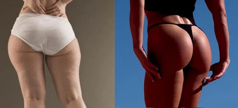 bunda_glúteos