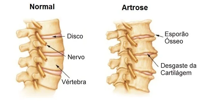 Dores na Cervical Artrose