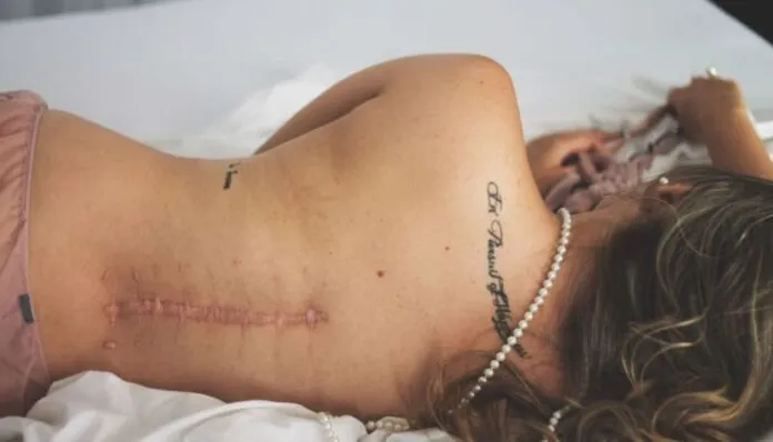 Imagem de uma mulher deitada mostrando cicatriz na coluna após cirurgia.