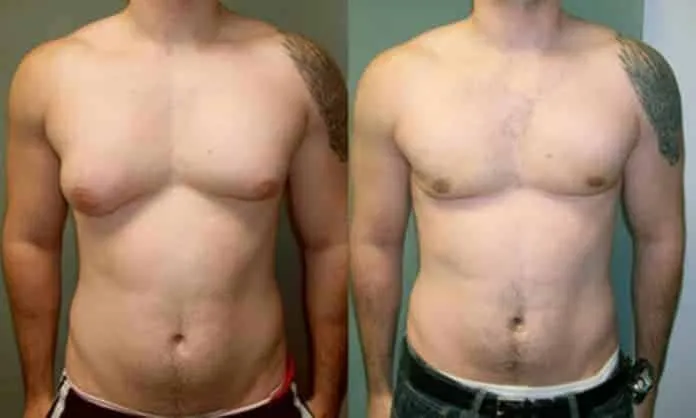 Antes e Depois Ginecomastia Antes e Depois Ginecomastia