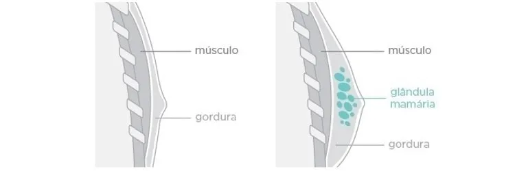 Ilustração da ginecomastia com glândula mamária aumentada.