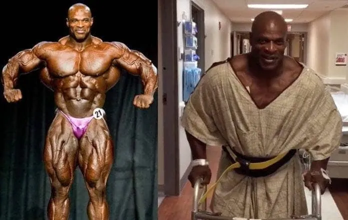 Ronnie Coleman e sua transformação Fisiculturista Ronnie Coleman em competição e após cirurgia.